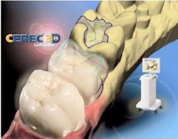 CEREC — State of the art technology